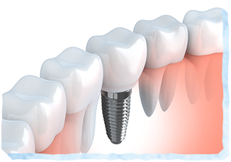インプラント・義歯