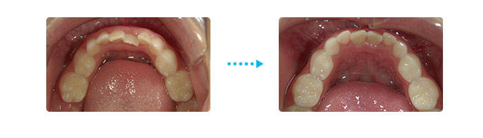 期間７カ月 状態：ＭＦＴの歯列への効果 下の前歯のガタガタが改善