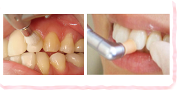 歯ブラシでは取りきれない歯のすみずみ、更には歯茎の中まで磨きあげます!