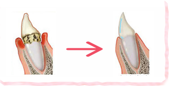 歯がツルツルになることで、むし歯、歯周病の原因であるバイオフィルムが付きにくくなります!