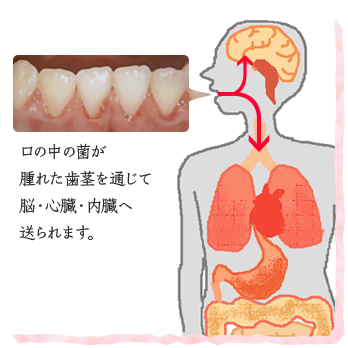 歯ぐきの炎症を抑える効果があるので、口腔から体内への細菌の侵入をブロック!全身の病気の予防にも効果的です。