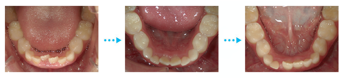 歯並び経過