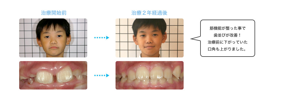 筋機能が整った事で歯並びが改善!治療前に下がっていた口角も上がりました。